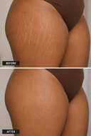 Striae & Darkspots Routine: Glow Bar + Glow Serum