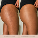Striae Glow Bar
