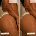 Striae Glow Bar